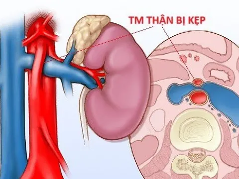 3 năm đau bụng không tìm được nguyên nhân: BS cảnh báo hội chứng gặp ở người bụng phẳng