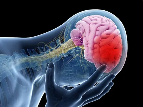 Đột quỵ sẽ tăng vọt, đặc biệt ở châu Á: Cảnh báo 4 lý do chính