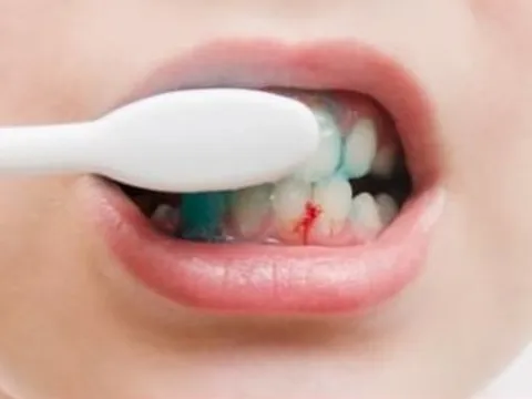 Dấu hiệu khi đánh răng cảnh báo gan nhiễm mỡ