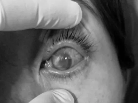 Tự mua thuốc điều trị đau mắt đỏ, bệnh nhân nữ bị loét giác mạc, mủ tiền phòng