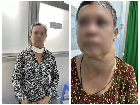 30 năm sống chung với bướu cổ, thở không được mới đi khám