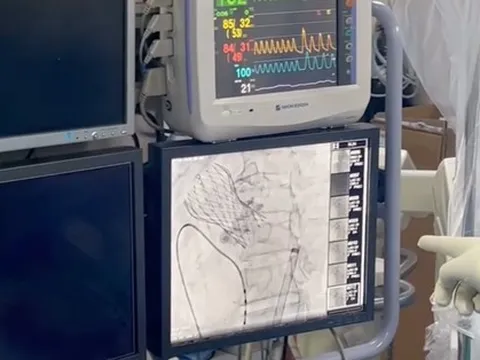 CLIP: Thay van trong van tim lần đầu tiên tại Việt Nam