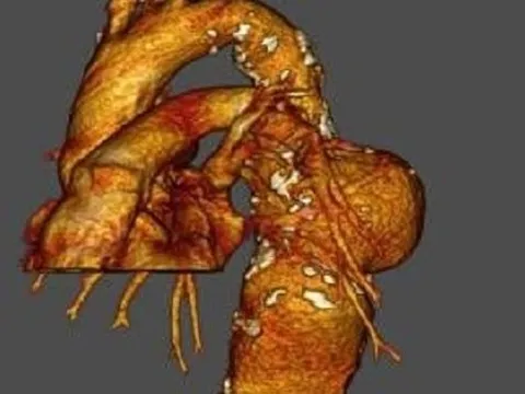 Cứu sống người đàn ông bị vỡ túi phình động mạch khi đang...chạy xe máy