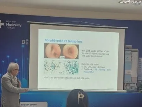 Phát hiện bệnh u phổi hiếm gặp ở người trẻ