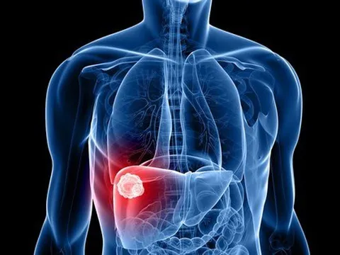 6 dấu hiệu cảnh báo ung thư gan nhiều người bỏ sót