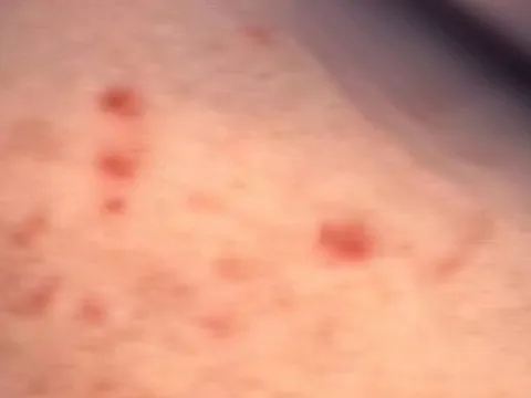 Người đàn ông có bạn tình cả 2 giới, bị lở loét vùng kín