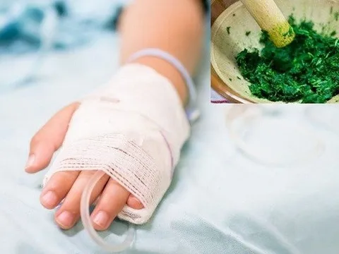 Cháu bé 14 tuổi hoại tử ngón tay do tự ý đắp thuốc lá của thầy lang