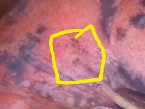 Lỗ rò xì bất thường trên người đàn ông 30 năm hút thuốc lá