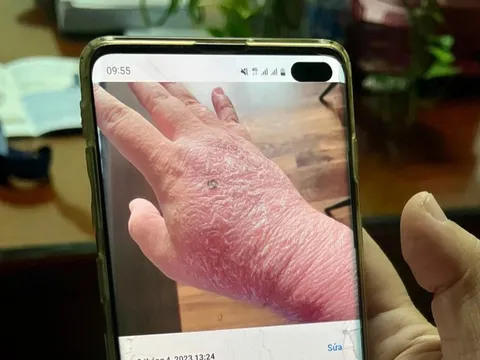 Tắm thuốc trị vảy nến, nữ bệnh nhân bội nhiễm toàn thân