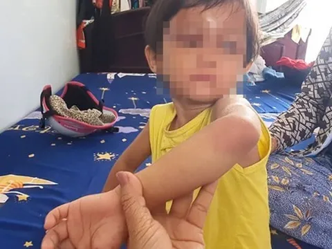 Làm rõ vụ bé gái 4 tuổi bị cha nuôi đánh gây thương tích