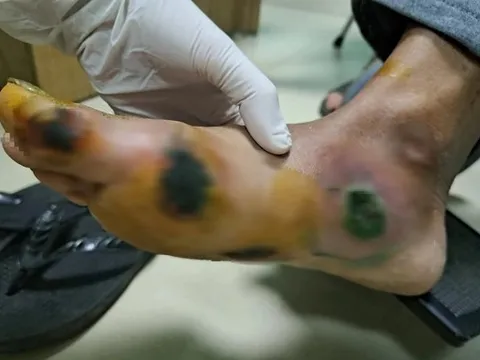 Bệnh nhân đái tháo đường loét bàn chân do thói quen thường gặp