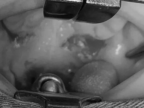 Chạy ngã khi đang ngậm que gỗ, bé trai bị đâm thủng vòm hầu