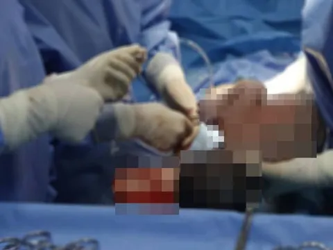 Cứu sống sản phụ bị vỡ tử cung khi đang chuyển dạ sinh con thứ 5