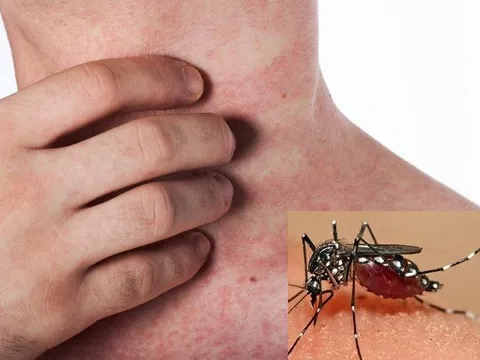 Mắc căn bệnh quen thuộc, người phụ nữ không thể ngủ vì cảm giác "giòi bò trong xương"