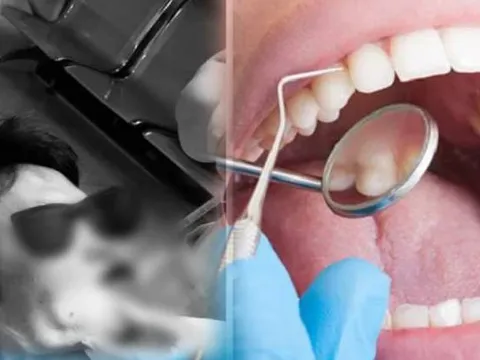 Lần đầu đi lấy cao răng bị chảy máu ồ ạt, bệnh nhân không ngờ bị ung thư máu