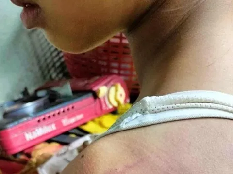 Nữ sinh lớp 4 bị 10 bạn cùng lớp đánh hội đồng bầm tím khắp người