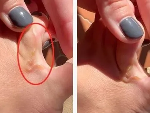 Chân ngứa dữ dội, cô gái phát hiện thứ kinh dị đang di chuyển dưới da