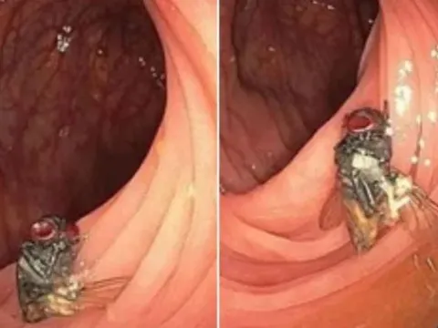 Bác sĩ sốc khi phát hiện con ruồi còn nguyên vẹn trong ruột bệnh nhân, nhận xét "rất hiếm gặp"