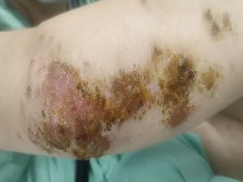 Nhiễm khuẩn, phù nề sau khi tắm bằng thuốc nam