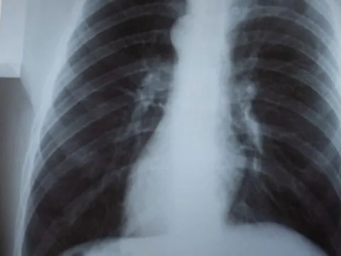 Thái Lan sẵn sàng các phương án đối phó với khả năng bùng dịch hô hấp ở trẻ