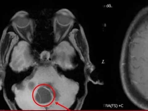 Sán làm tổ trong não do thói quen ăn tiết canh