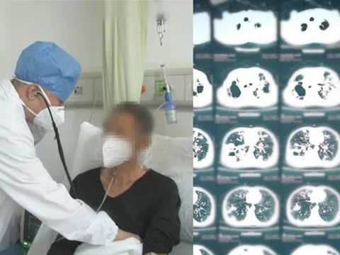 Người đàn ông hai nửa phổi gần như "biến mất", vĩnh viễn không thể phục hồi do một thói quen kinh hoàng suốt 20 năm