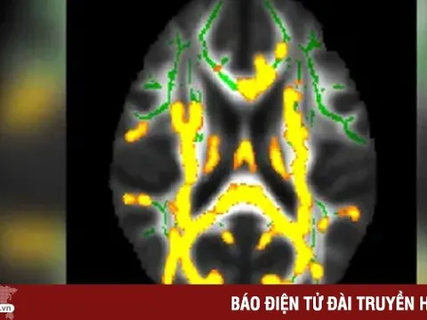 Nghiên cứu cho thấy mỡ bụng ẩn có liên quan đến viêm não và chứng mất trí nhớ