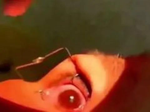 Hơn 60 con giun bò ngoe nguẩy trong mắt người phụ nữ