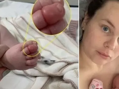 Em bé sơ sinh suýt mất ngón chân chỉ vì sợi tóc của mẹ