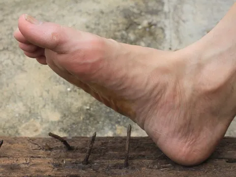 Giẫm phải chiếc đinh nhỏ, người đàn ông phải thở máy gần 1 tháng: Bác sĩ cảnh báo