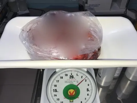 Đồng Nai: Cắt bỏ khối u nặng 2,5kg trong ngực người đàn ông