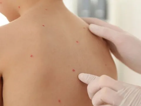 Ghi nhận ổ dịch thủy đậu tại một trường mầm non ở Đắk Lắk