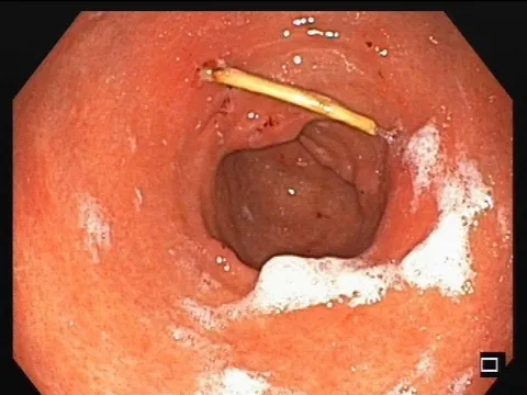 Nội soi gắp que tăm dài 3cm trong thành dạ dày của người đàn ông