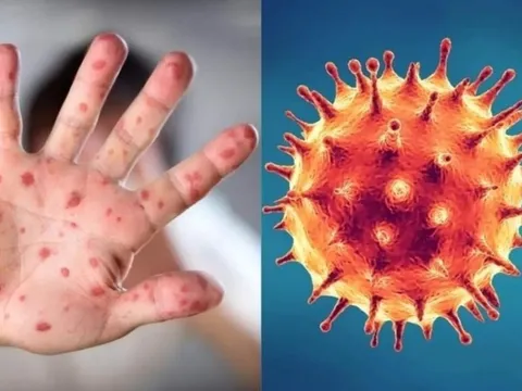 Cà Mau: Phát hiện một trường hợp nghi mắc đậu mùa khỉ