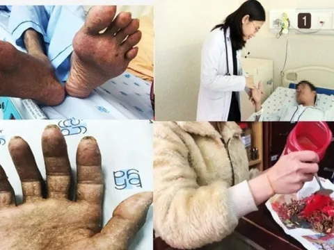 Liên tiếp các trường hợp nhiễm độc thạch tín do thói quen sinh hoạt hằng ngày