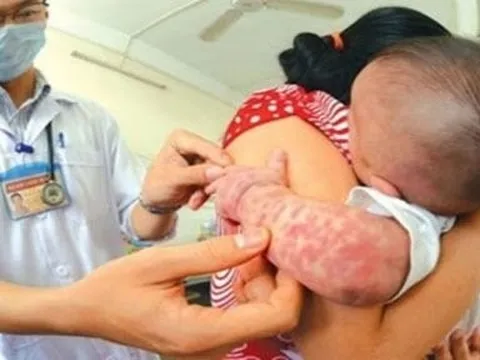 Bộ Y tế yêu cầu giám sát phát hiện sớm, xử lý triệt để ổ dịch sởi