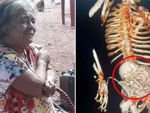 Cụ bà tử vong sau ca phẫu thuật lấy thai nhi vôi hóa "56 tuổi" ra khỏi bụng