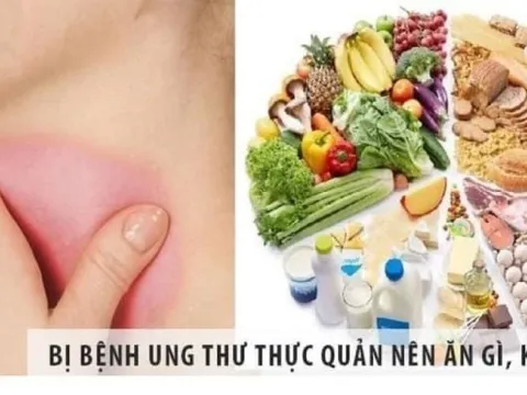 9 dấu hiệu giúp bạn nhận biết ung thư thực quản sớm nhất