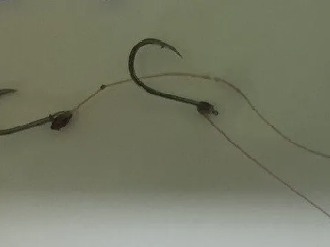 Nội soi gắp lưỡi câu cùng dây cước mắc kẹt trong thực quản của bé trai