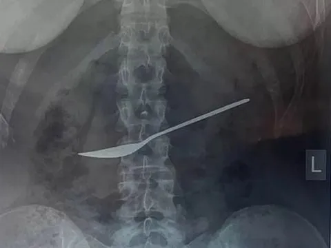 Đau bụng nhập viện, bác sĩ sốc nặng khi lấy ra thứ trong bụng cô gái