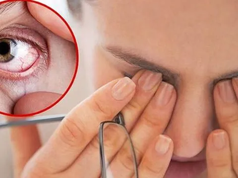 Nhiều người gặp tình trạng khô mắt do nằm điều hòa thường xuyên