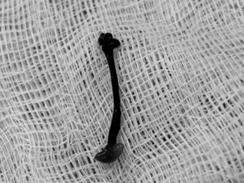 Bé trai hơn 2 tuổi mũi rỉ máu kéo dài, bác sĩ gắp ra thứ "đáng sợ" bên trong